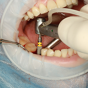 Are Dental Implants Safe? | El Paso, TX