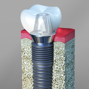 Dental Implant Restoration – The Age Factor