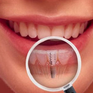 No Better Choice Than Dental Implants!