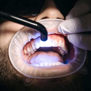 5 Reasons for Teeth Whitening This Summer | El Paso