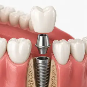 Helpful dental information about dental implants El Paso