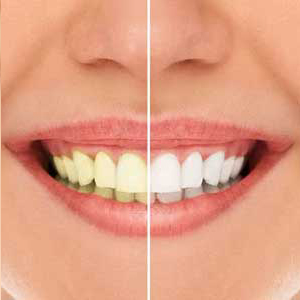 Teeth Whitening: How Long Does the Whitening Stay? | El Paso