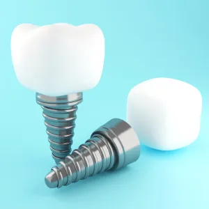 The Step-by-Step Process of Dental Implants in El Paso