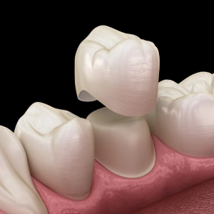 Top Myths and Facts About Dental Crowns in El Paso