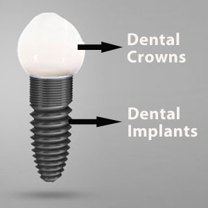What Splits Dental Crowns From Dental Implants?