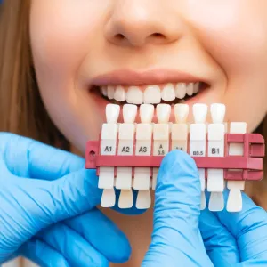 What to Expect When Getting Dental Veneers in El Paso