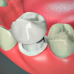Dental Crowns