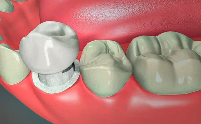 Dental Crowns El Paso Texas