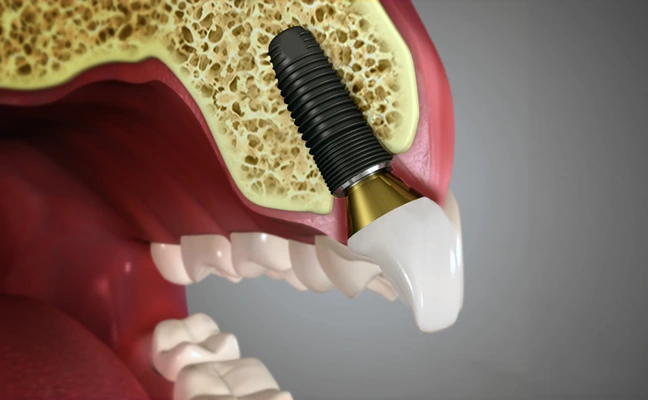 Dental Implants El Paso Texas