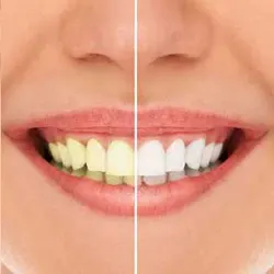 Teeth Whitening
