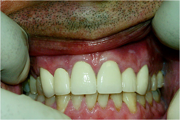 Dental Crowns and Bridges After