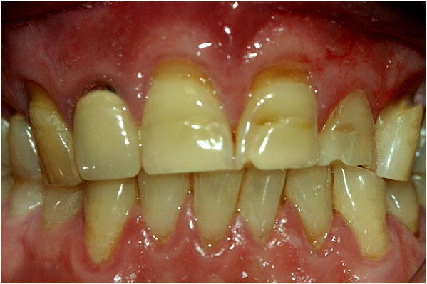 Dental Crowns and Bridges Before