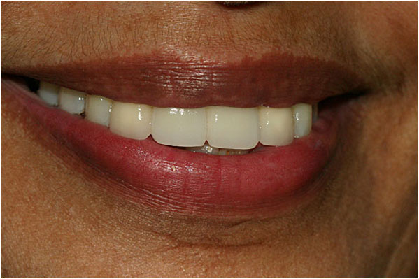 Dental Implants After