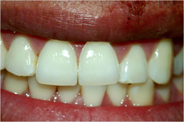 Dental Crowns and Bridges After