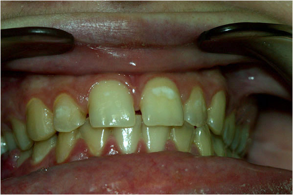 Dental Veneers Before
